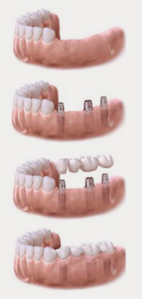 dental implant