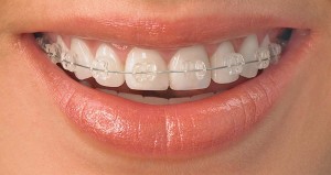 ceramic braces