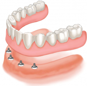 dental implant