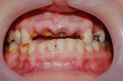 Dental implant surbiton