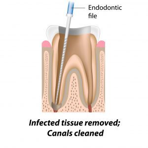 Root Canal Treatment - Infected Tissues Removed, Canals Cleaned - Surbiton Smile Centre