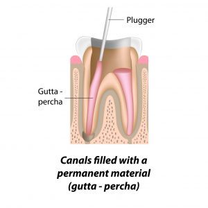Root Canal Treatment - Canals Filled with a permanent material (gutta - percha) - Surbiton Smile Centre