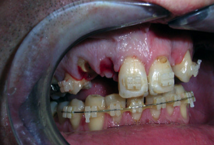 full mouth reconstruction full mouth reconstruction