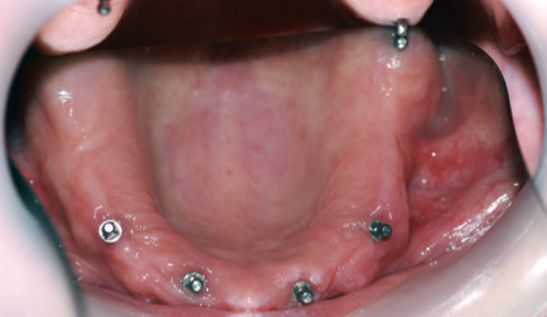 Five implants in Lower Jaw fitted