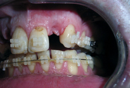 full mouth reconstruction