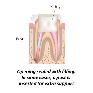 Root Canal Treatment - Opening Sealed With Filling - Surbiton Smile Centre