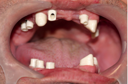 dental implant case dental implant case