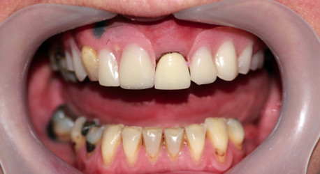 dental implant surbiton