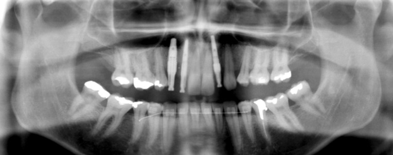 full mouth reconstruction full mouth reconstruction
