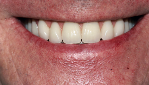 dental implant dental implant case after treatment