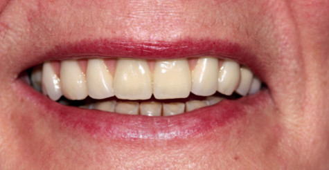 surbiton dental implant