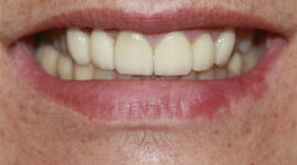 Emax Veneers - cosmetic Dentistry