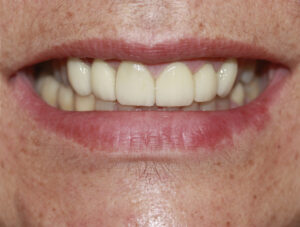 Emax Veneers - cosmetic Dentistry