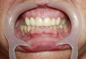 Emax Veneers - cosmetic dentistry treatment