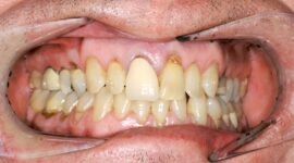Emax ceramic crowns - case study - before
