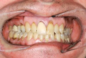 Emax ceramic crowns - case study - before