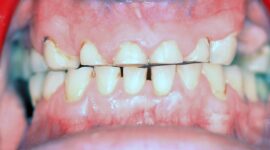 cosmetic dental treatment - Teeth grinding - before