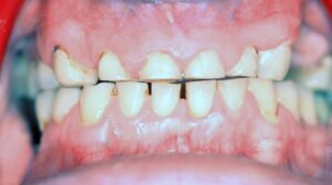 cosmetic dental treatment - Teeth grinding - before