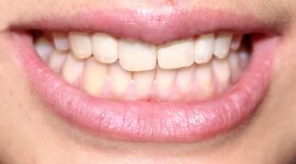 Chipped tooth dentistry - after