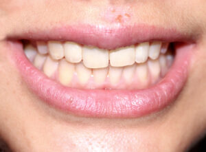 Chipped tooth dentistry - after