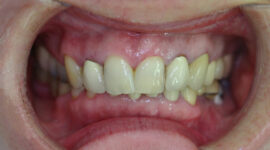 Cosmetic Dentistry - Case study - before