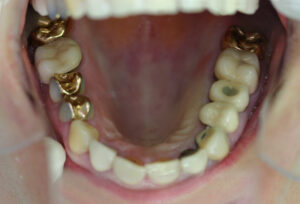 Cosmetic dentistry - before