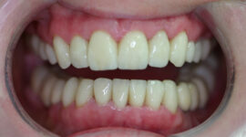 Cosmetic Dentistry - case study - after