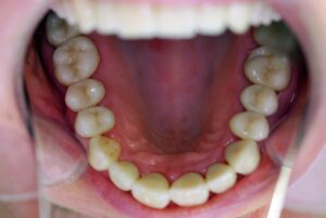 Cosmetic Dentistry - Top Jaw after