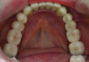 Cosmetic dentistry - bottom jaw after