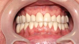 Cosmetic Dental Treatment -Case study - after