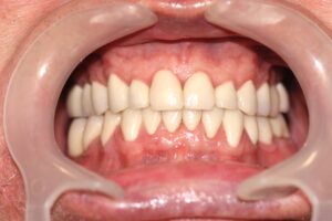 Cosmetic Dental Treatment -Case study - after