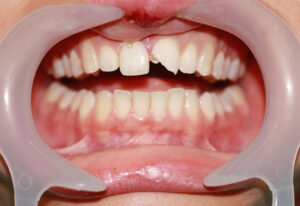 Chipped tooth dental treatment