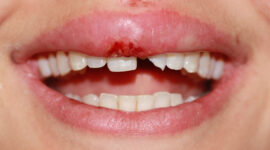 Chipped tooth - case study - before