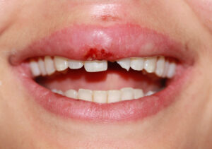 Chipped tooth - case study - before