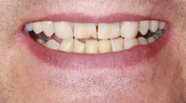 Emax Ceramic Crowns - before