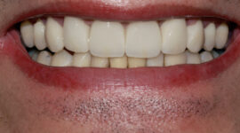 Emax Ceramic Dental Veneers - case study - After