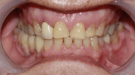 Crooked unsightly teeth - before