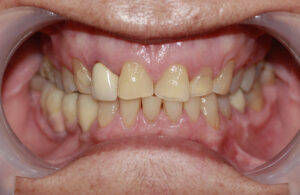 Crooked unsightly teeth - before