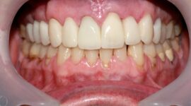 Emax Ceramic Crowns - After Dental Treatment