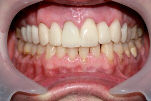 Emax Ceramic Crowns - After Dental Treatment