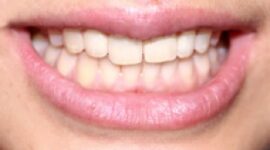 chipped-front-tooth-after
