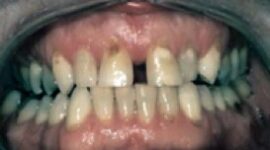 cosmetic-gap-front-teeth-before
