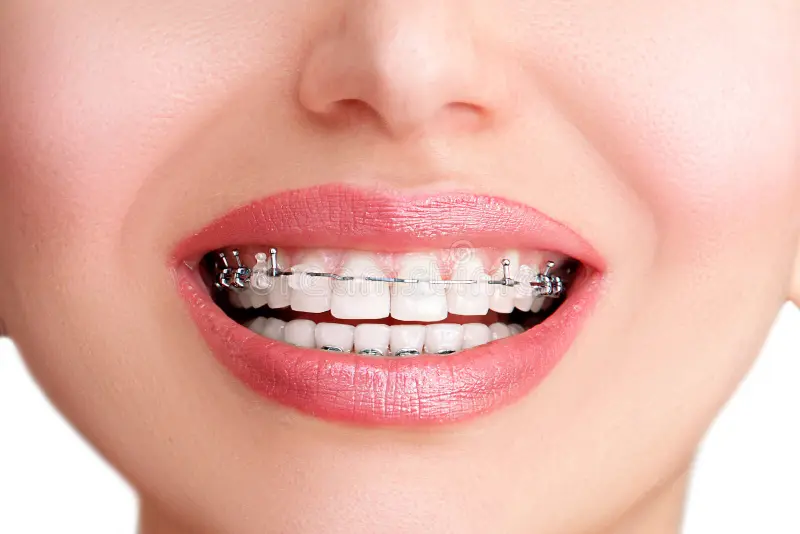 closeup-ceramic-metal-braces-teeth-beautiful-female-smil-close-up-open-mouth-white-broad-smile-self-ligating-brackets-129379614