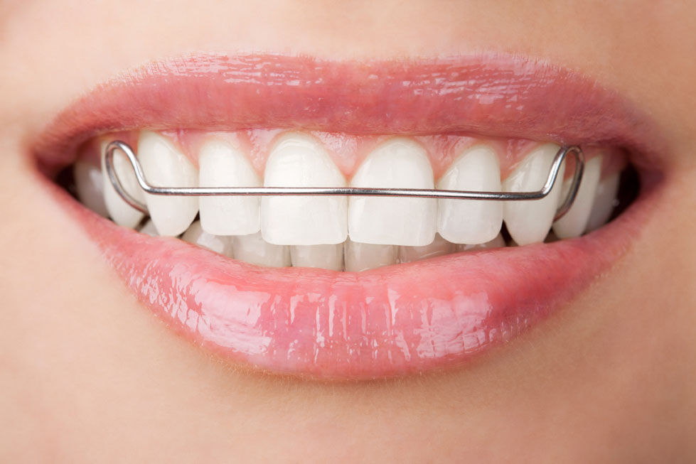inman aligners