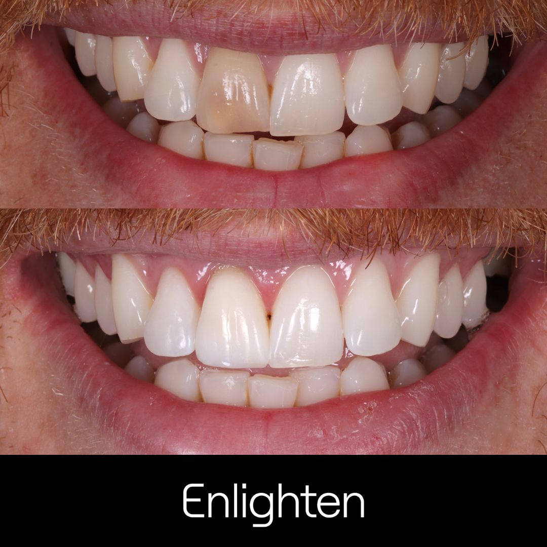 Teeth Whitening in Surbiton