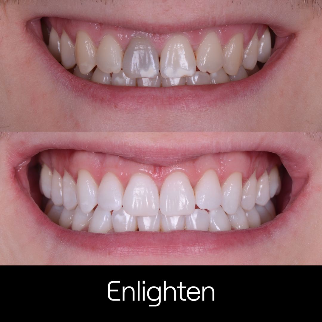 Teeth Whitening Surbiton