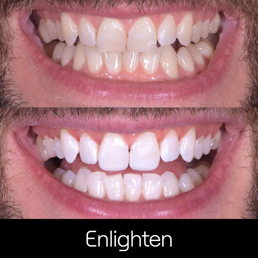 Teeth Whitening Surbiton