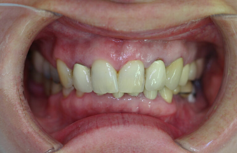 CT-5-1-Full-mouth-before-768×496