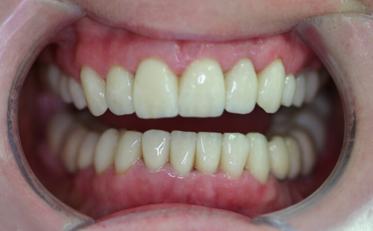 CT-5-6-Full-mouth-after-768×477