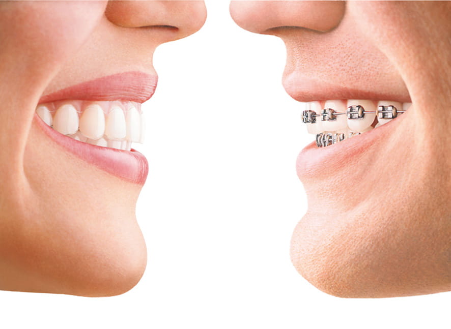 Invisalign vs traditional braces Invisalign vs traditional braces